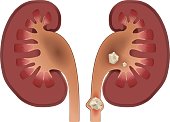 Nephrolithiasis kidney stones disease