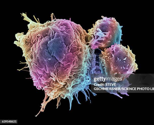 cancer cell and t lymphocytes, sem - elektronenmikroskopische aufnahme stock-fotos und bilder