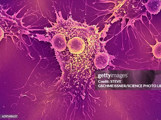 cancer cell and t lymphocytes, sem - micrografía científica fotografías e imágenes de stock