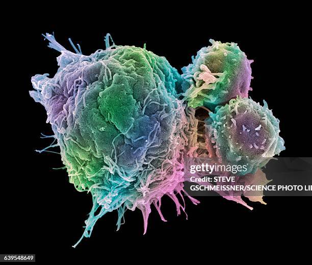 cancer cell and t lymphocytes, sem - micrografia elettronica a scansione foto e immagini stock