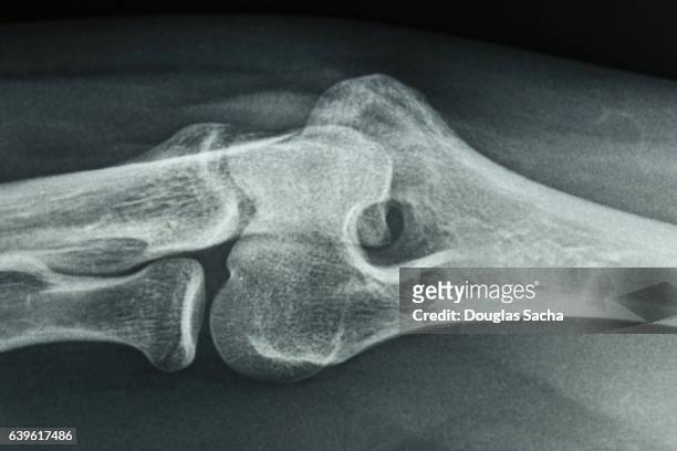 orthopedic x-ray image of a human elbow - x ray arm stock pictures, royalty-free photos & images