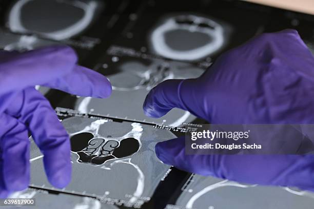 oncology surgeon examines x-ray images prior to removing the cancerous tumor - biopsy stock pictures, royalty-free photos & images