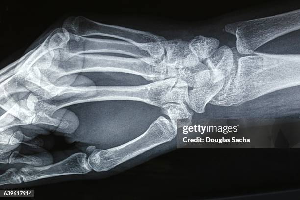 close up of a hand and wrist x-ray film - wrist stock pictures, royalty-free photos & images