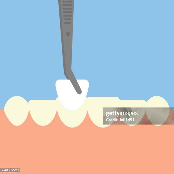 illustrazioni stock, clip art, cartoni animati e icone di tendenza di l'impiallacciatura sui denti. design piatto - extraction forceps