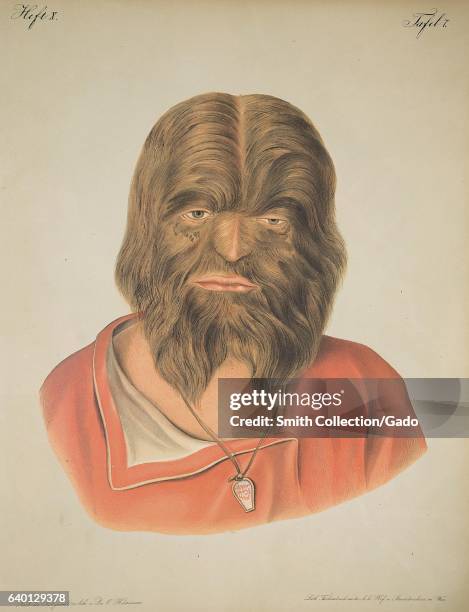Lithograph showing a man whose face is covered in hair, in "Atlas der Hautkrankheiten" by Ferdinand Ritter von Hebra , 1856. Courtesy National...