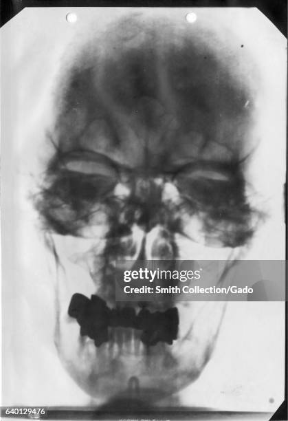 Ray of the head of Adolf Hitler , 1930. Courtesy National Library of Medicine. .