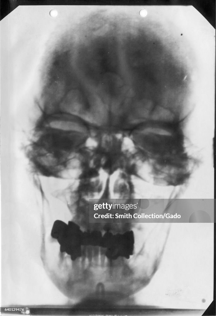 Ray Hitlér X-ray of the head of Adolf Hitler , 1930. Courtesy National Library ...
