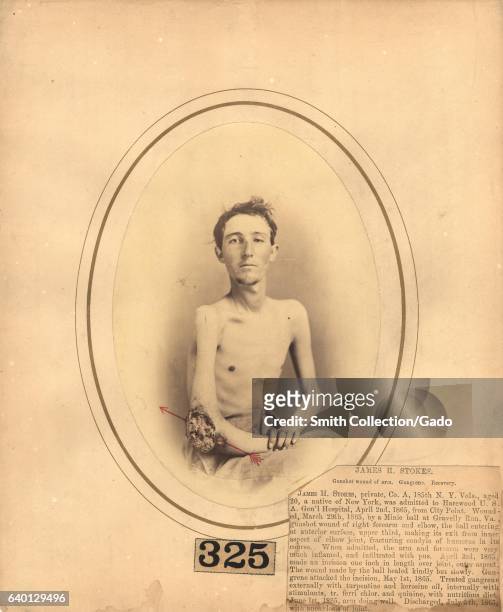 Photograph of a seated shirtless man facing the camera and exposing his left gangrenous elbow taken by photographer Reed Brockway Bontecou , 1865....