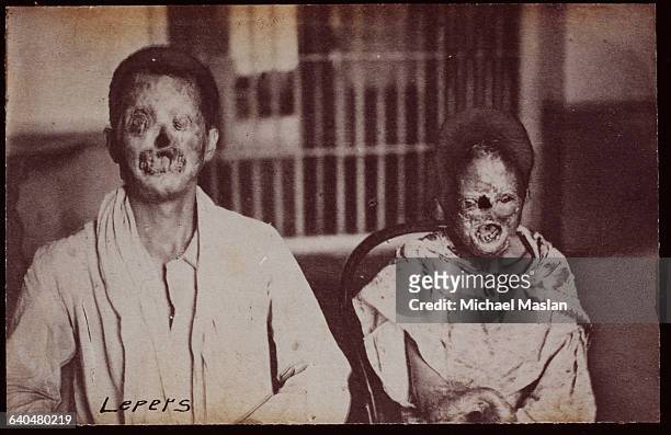 Illustrating the grossly disfiguring effects of leprosy, two victims in China, ca. 1880s-1890s.