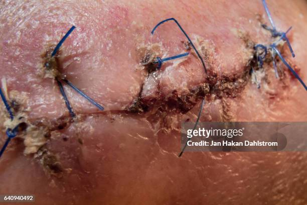 surgery scar with sutures - suturar - fotografias e filmes do acervo