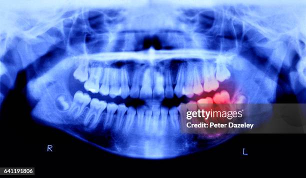 toothache pain - human jaw bone stockfoto's en -beelden