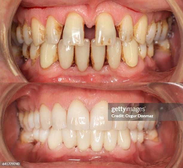 teeth restoration - before and after teeth stock pictures, royalty-free photos & images