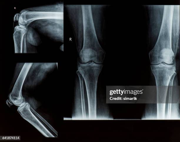 x-ray of knee - x ray image stock pictures, royalty-free photos & images