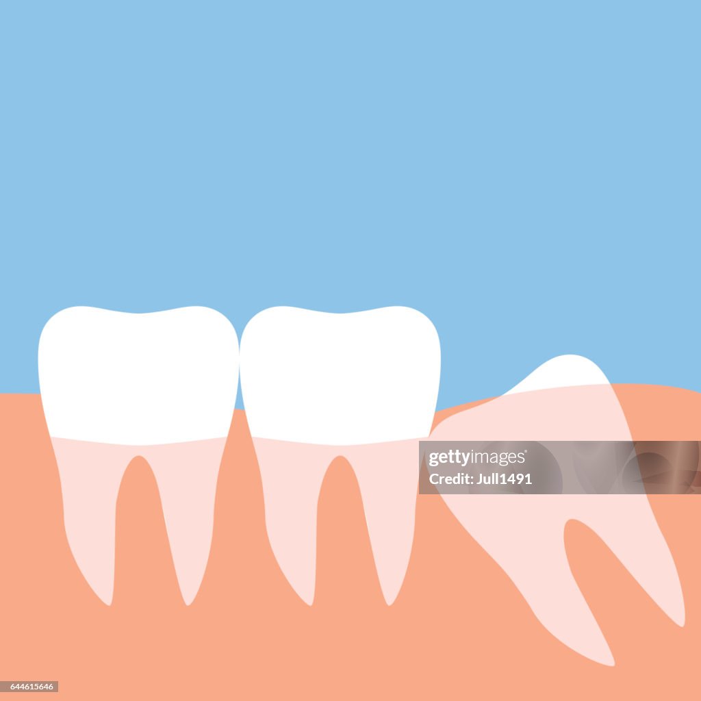 The wisdom tooth.