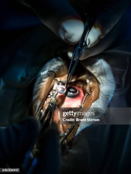 Corneal graft is performed at the Vivekananda Mission Asram hospital on the outskirts of Kolkata. A cornea from a deceased donor is cut to precise...