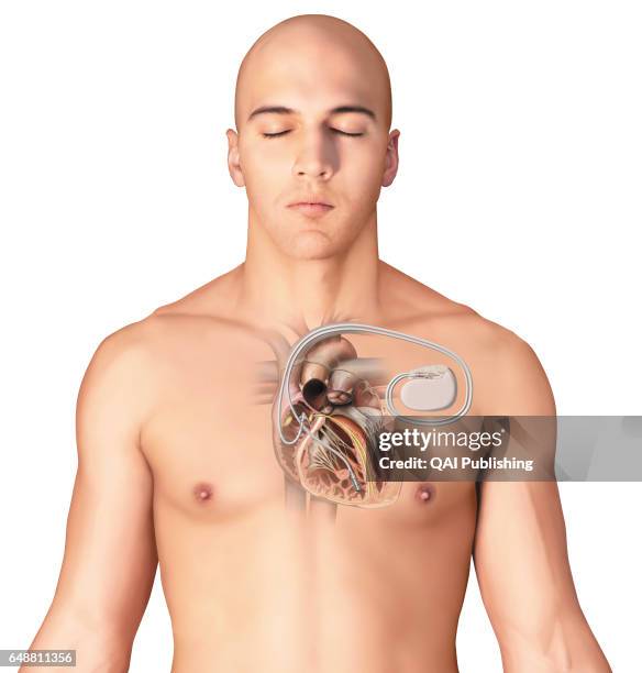 Future Pacemaker Image 225 Pacemaker Patient Stock Photos, High-Res Pictures, and Images ...