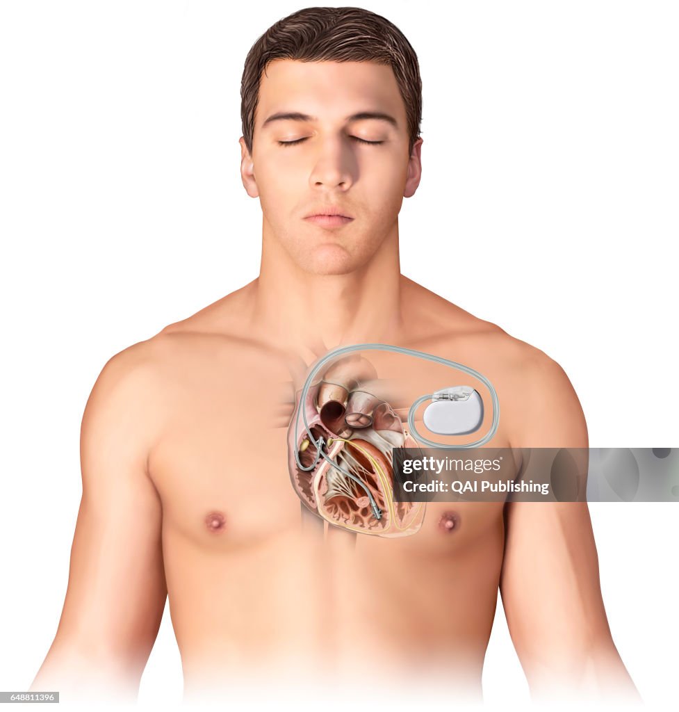 Artificial pacemaker, Electronic implant that emits an electrical ...