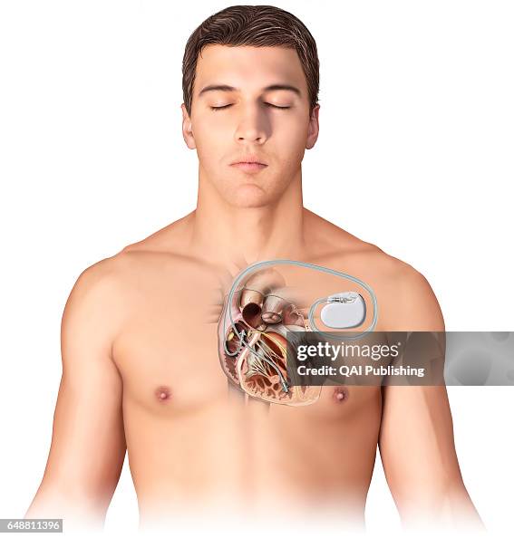 Gi Pacemaker Artificial pacemaker, Electronic implant that emits an electrical ...