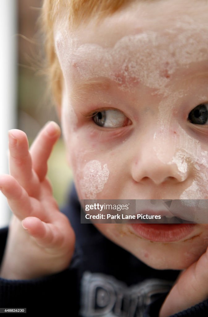 Child with chicken pox spots on face and calamine lotion.