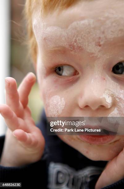 child with chicken pox spots on face and calamine lotion. - calamine-lotion stock pictures, royalty-free photos & images