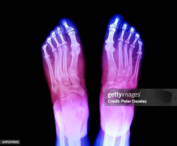 x-ray of feet showing arthritis - blood flow stock pictures, royalty-free photos & images