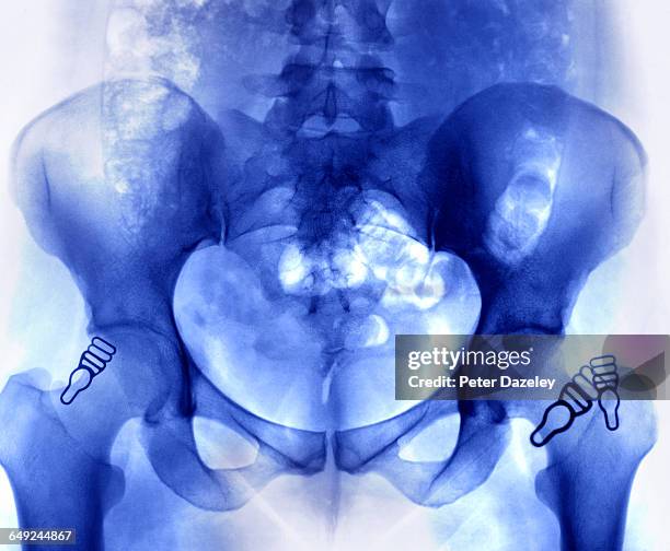 x-ray of pelvis showing stomach and suspenders - acetabulum stock pictures, royalty-free photos & images