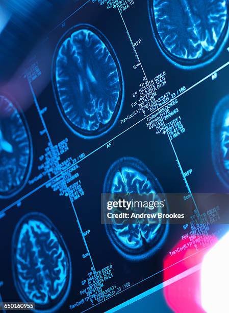 human brain scan in a neurology clinic - outil de diagnostic médical photos et images de collection