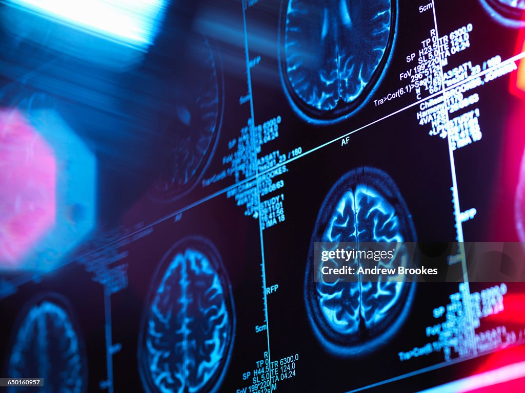Human brain scan in a neurology clinic