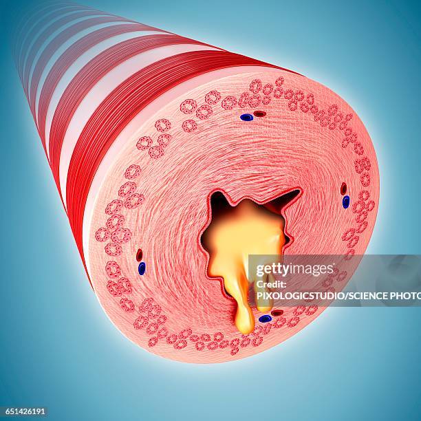 ilustraciones, imágenes clip art, dibujos animados e iconos de stock de infected human bronchus, illustration - vía-respiratoria