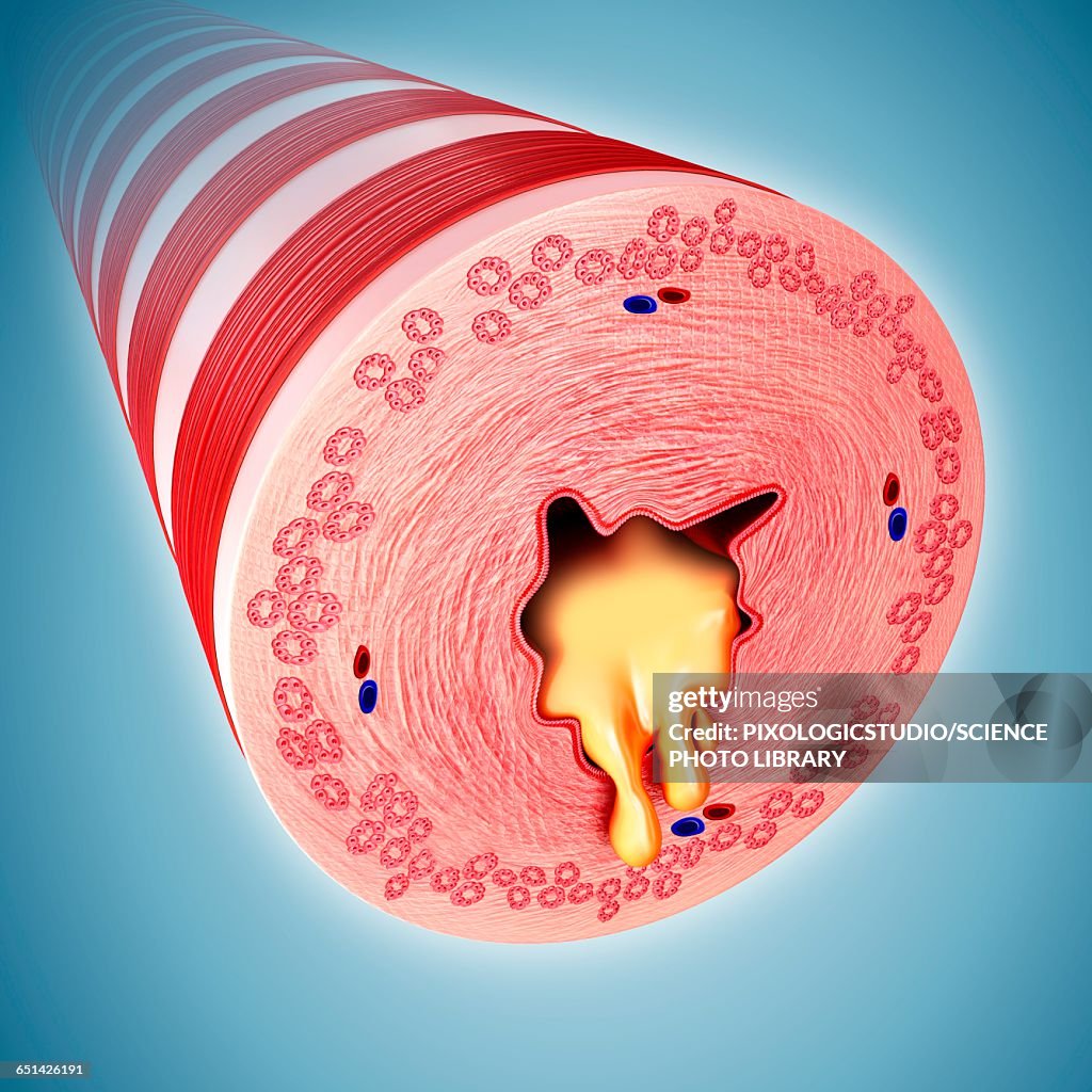 Infected human bronchus, illustration
