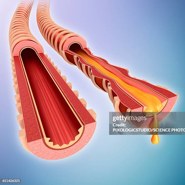 infected bronchus, illustration - mucus stock illustrations