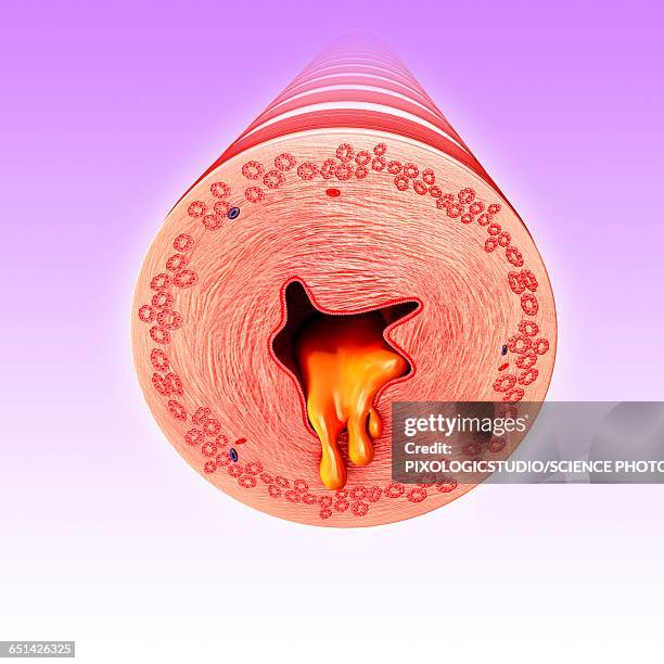 infected bronchus, illustration - mucus stock illustrations