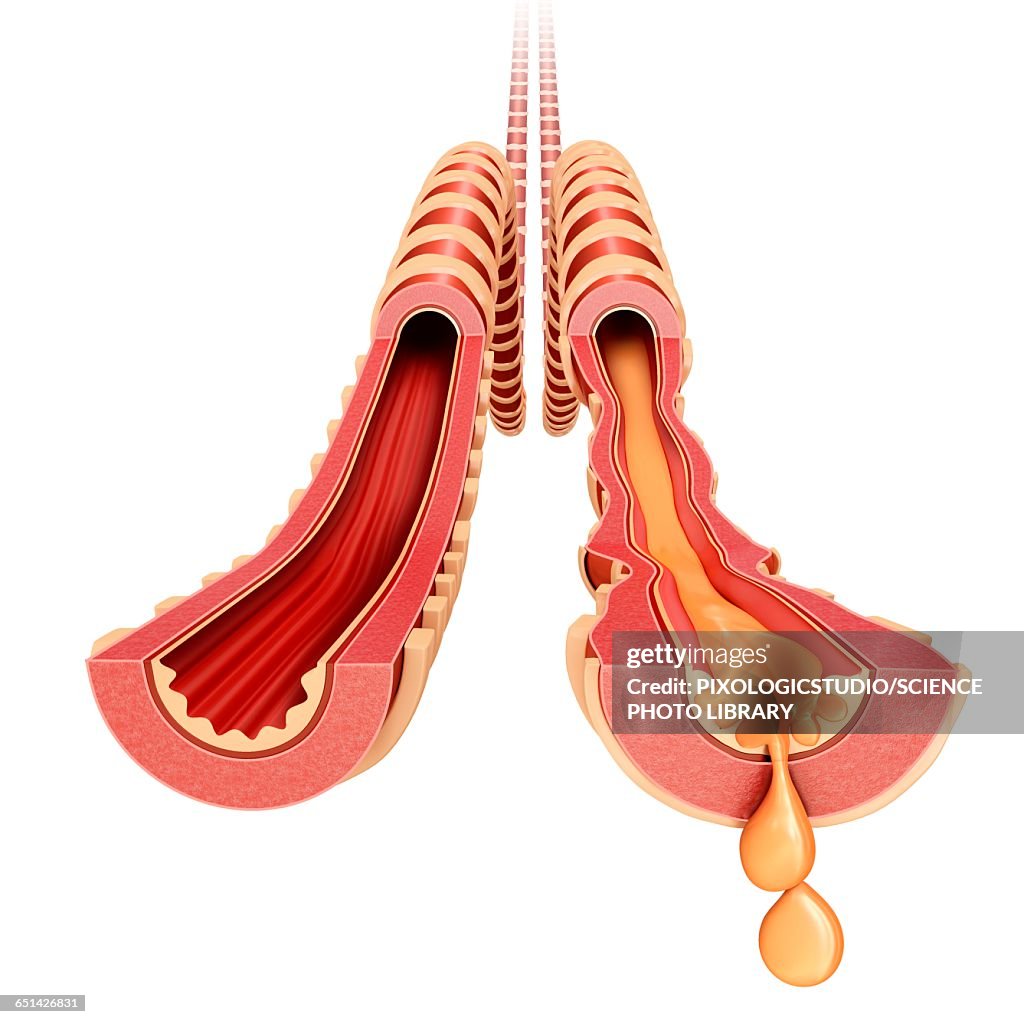 Infected bronchus, illustration