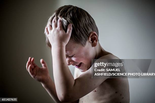 boy with chickenpox - pocken stock-fotos und bilder