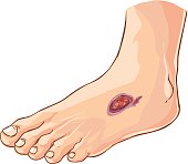 Vector illustration of a medical Diabetic foot