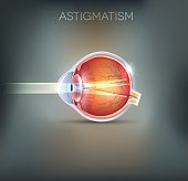 Astigmatism, vision disorder