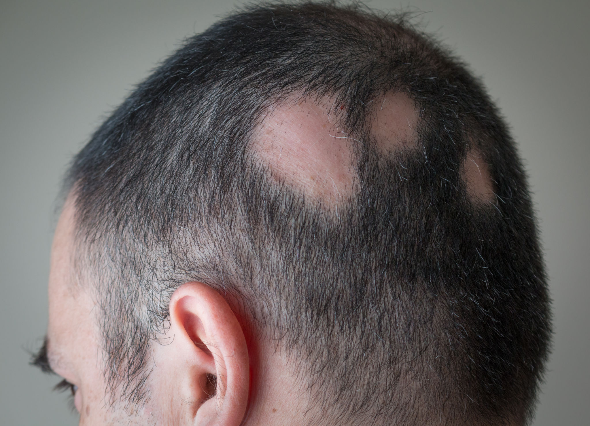 Alopecia Aerata - Spot Baldness Alopecia Aerata - Spot Baldness