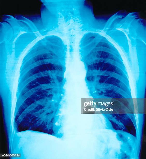 2,691 Chest Radiography Stock Photos, High-Res Pictures, and Images ...