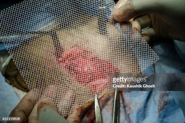surgeon holding polypropylene mesh during abdominal surgery for hernia repair - hernia mesh fotografías e imágenes de stock