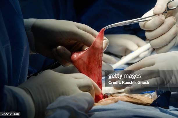 repair of intestine during abdominal surgery of inguinal hernia - inguinal hernia stock pictures, royalty-free photos & images