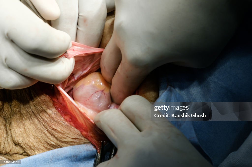 Human intestine through the hernia sac during abdominal surgery