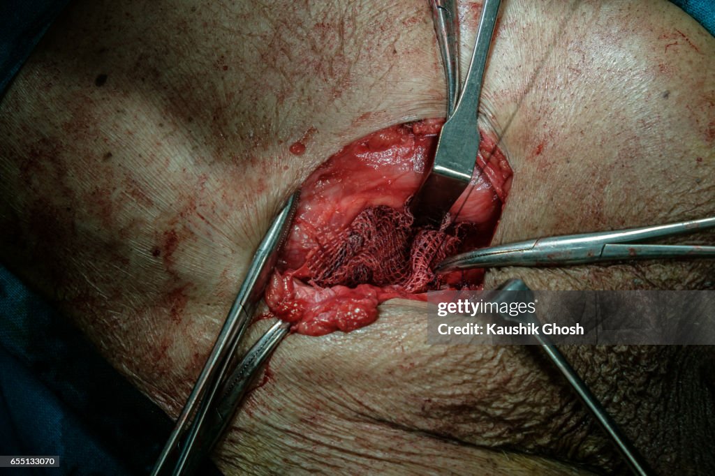 Implant of Polypropylene Mesh for hernia repair (abdominal surgery)