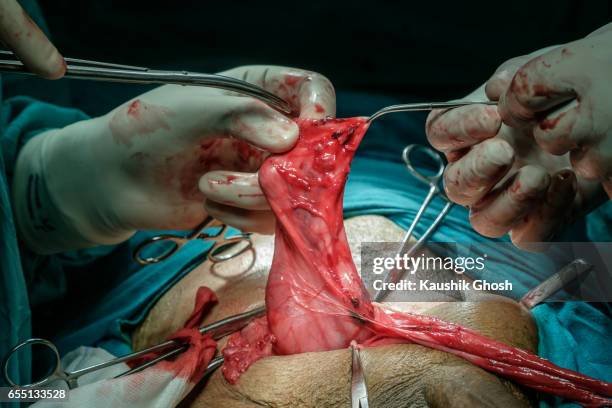 repair of intestine during abdominal surgery of inguinal hernia - inguinal hernia stock pictures, royalty-free photos & images