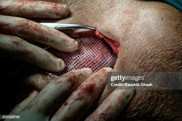 surgeon wearing gloves implanting polypropylene mesh for inguinal hernia repair (abdominal surgery) - hernia mesh fotografías e imágenes de stock