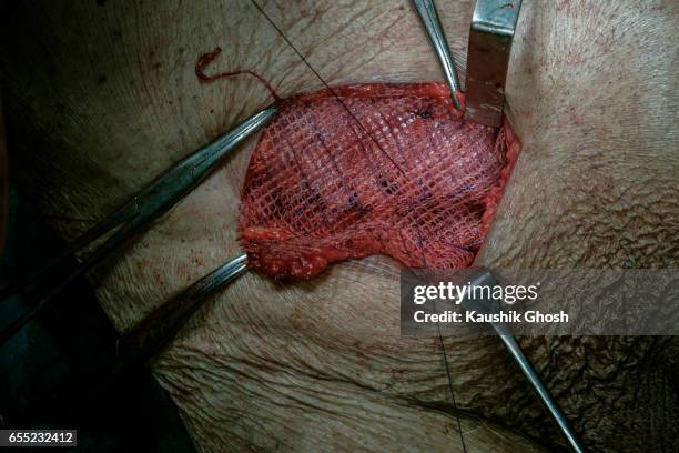 implant of polypropylene mesh after inguinal hernia repair (abdominal surgery) - hernia mesh fotografías e imágenes de stock