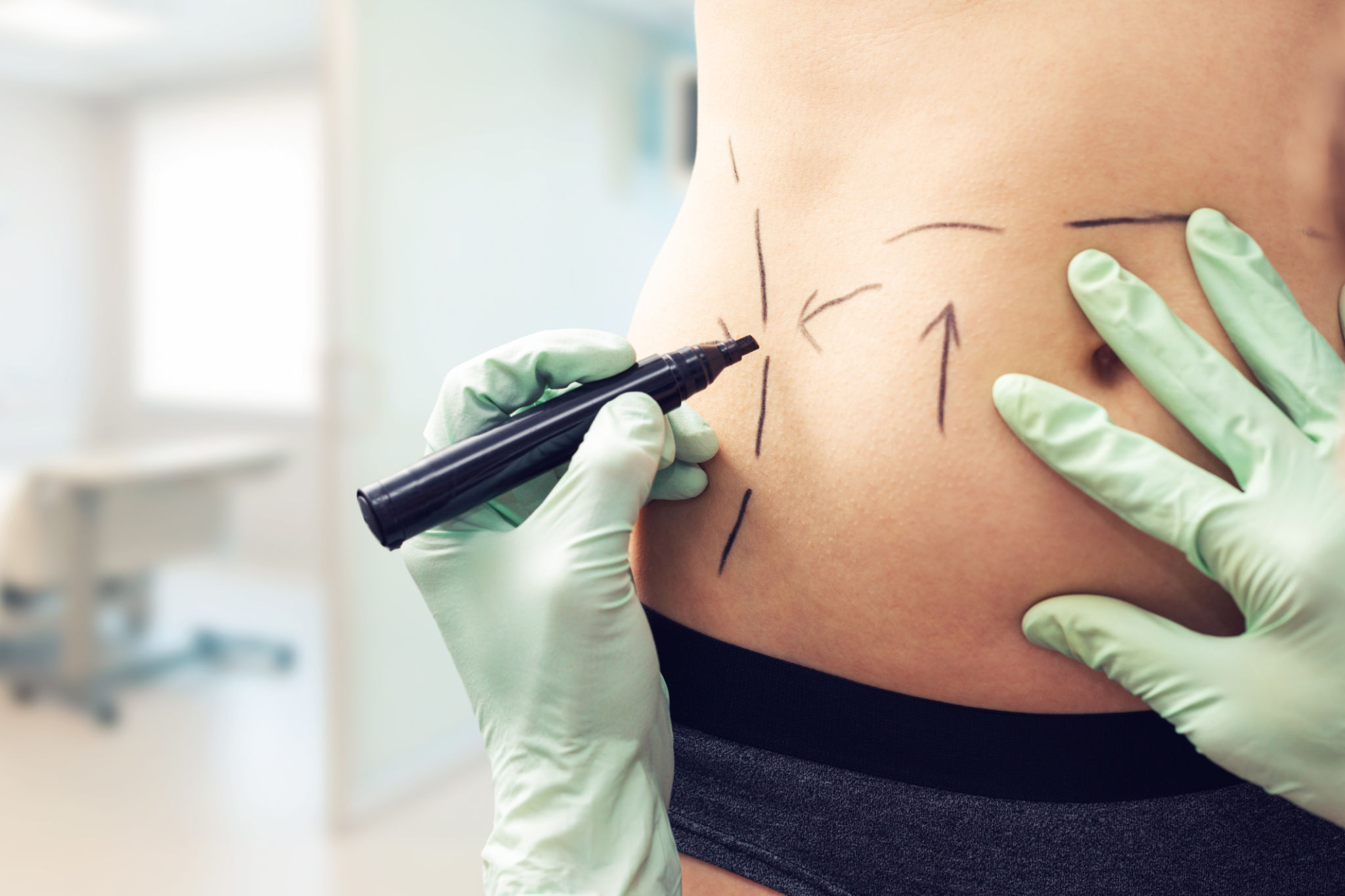 liposuction surgery