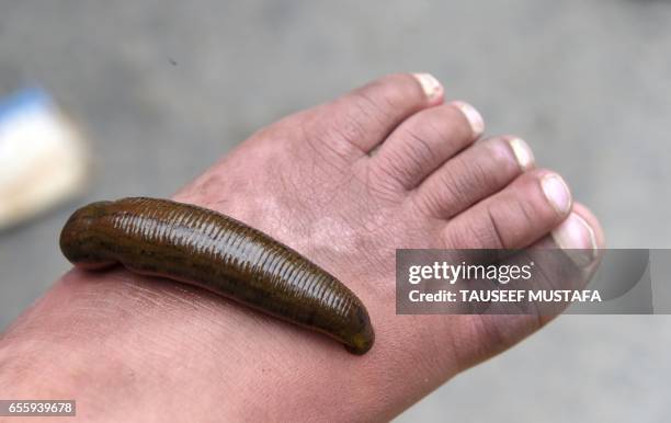 Leech sucks blood on the feet of a patient during a leech therapy session at a roadside stall in Srinagar on March 21, 2017. Leeches are often used...