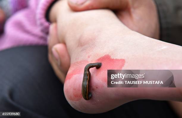 Leech sucks blood on the heel of a patient during a leech therapy session on a roadside in Srinagar on March 21, 2017. Leeches are often used to heal...