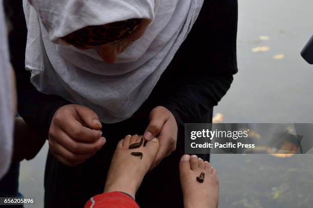 Leeches suck blood from a foot of a child after a traditional health worker uses leeches to suck blood as part of a treatment at Hazratbal on the...