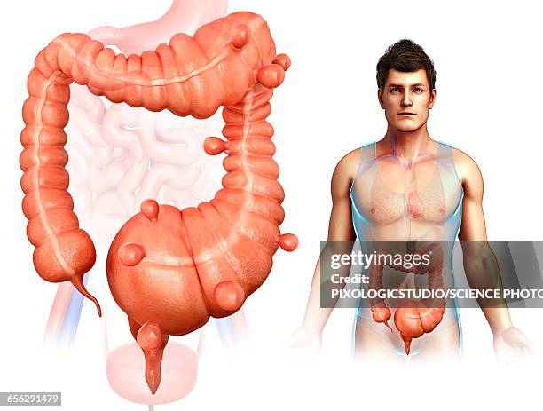 diverticulosis, illustration - diverticulosis stock illustrations